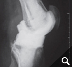 Implantierte Spacer nach Prothesenentfernung